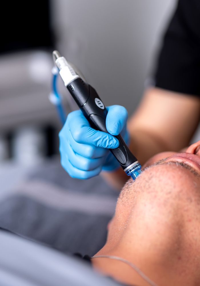 Facial treatment using a microneedling device.